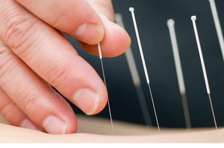 ACUPUNCTURE